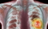 Aparat care depistează în timp record trei tipuri de cancer, folosit de o asociație din Prahova