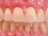 Implanturi dentare, înlocuite cu BIO-DINȚI creați din CELULE STEM
