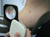 Noi descoperiri în tratarea celei mai agresive forme de cancer de piele