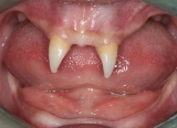 Un copil din China a şocat întreaga lume: I-au crescut dinţi de vampir